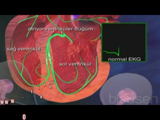 what is bradycardia (ecg learning)
