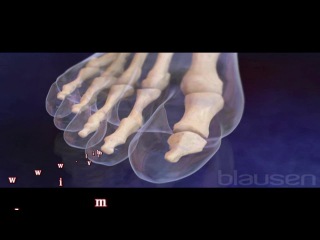 what is bunion disease?